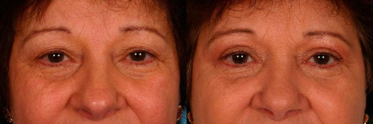 Eyelid Surgery (Blepharoplasty) Before & After Gallery - Patient 194674 - Image 2