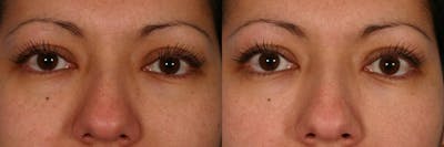 Restylane Before & After Gallery - Patient 834933 - Image 1
