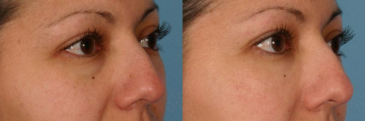 Restylane Before & After Gallery - Patient 834933 - Image 2