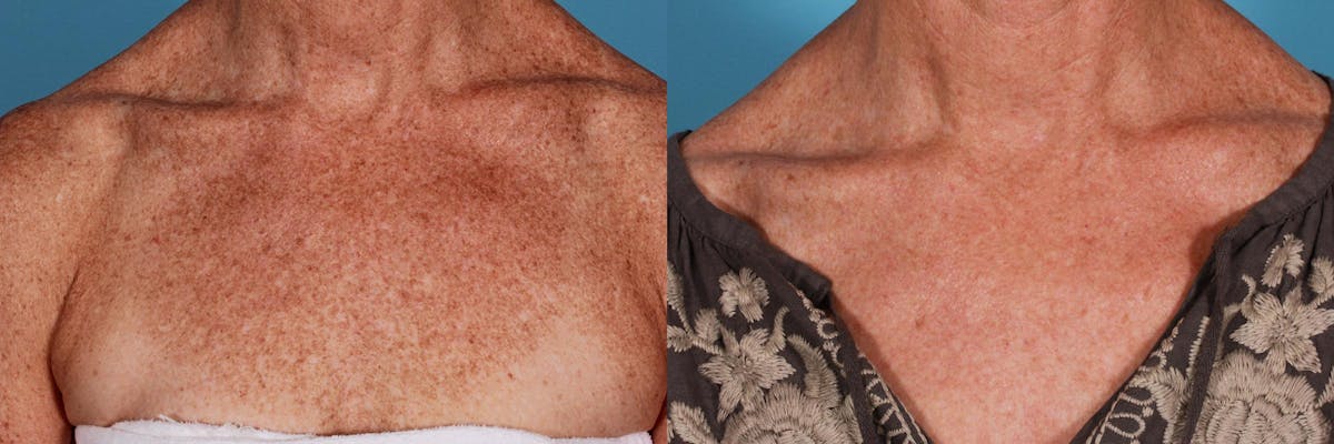 Lasers Before & After Gallery - Patient 125257 - Image 6