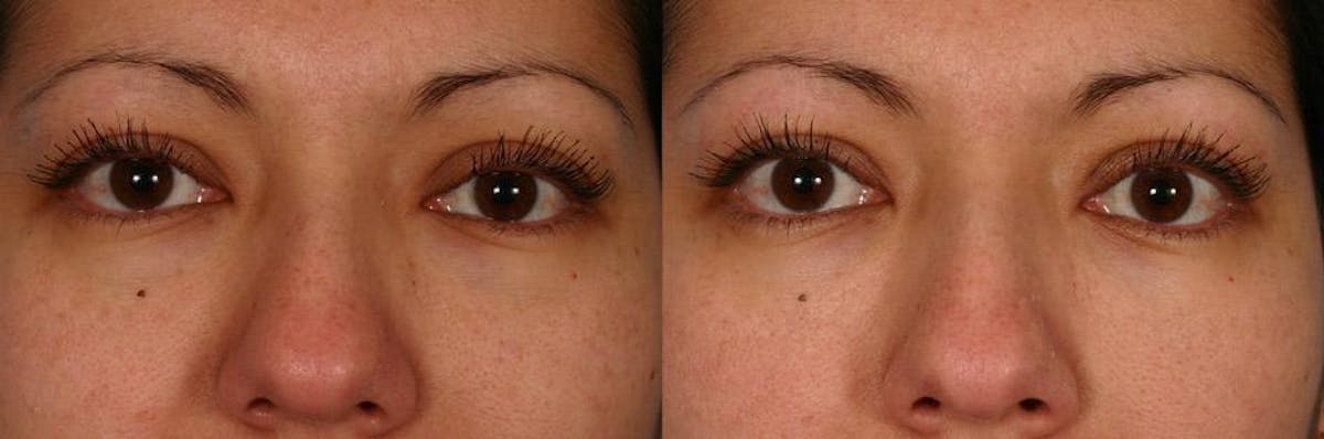 Restylane Before & After Gallery - Patient 834933 - Image 3