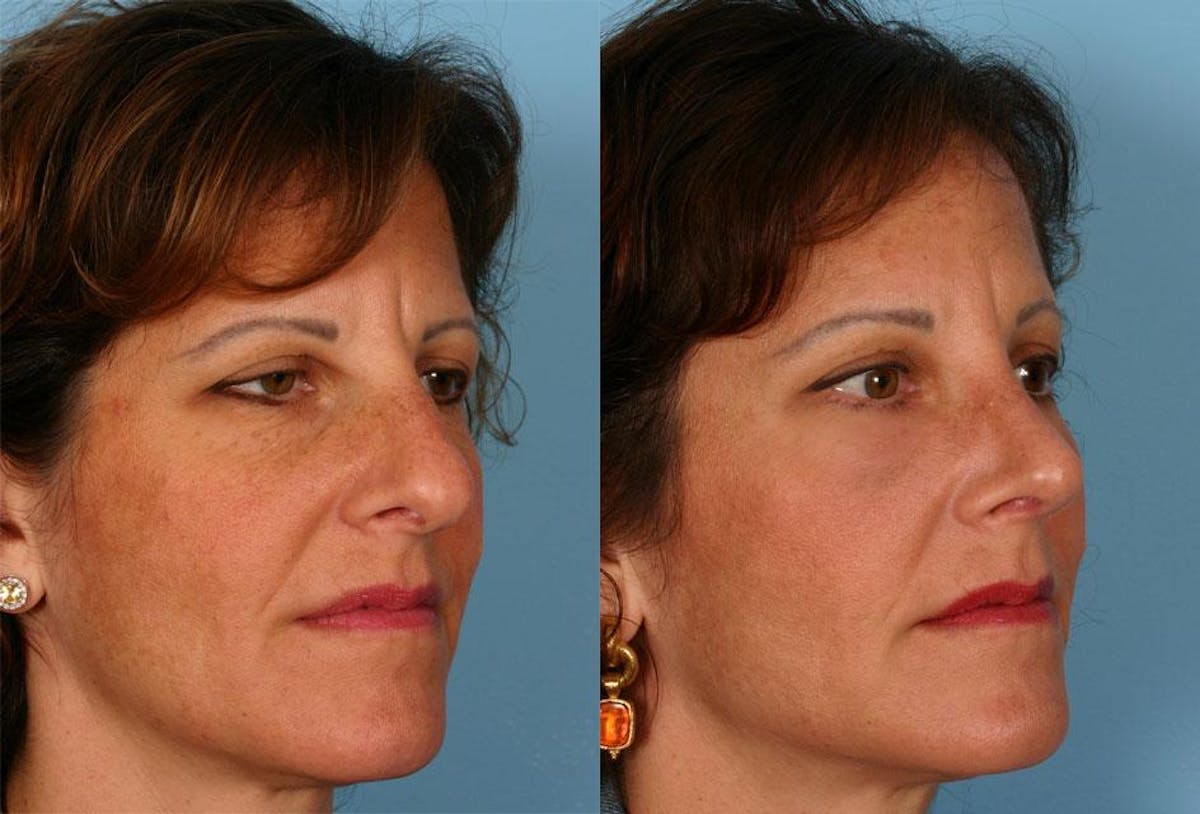 Eyelid Surgery (Blepharoplasty) Before & After Gallery - Patient 283287 - Image 2