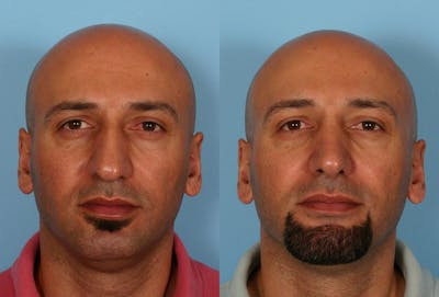 Rhinoplasty Before & After Gallery - Patient 260489 - Image 1