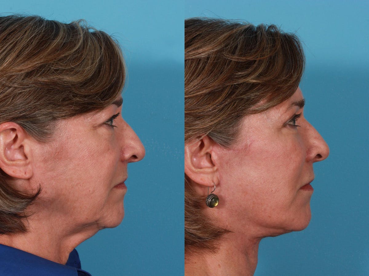 Facelift Before & After Gallery - Patient 162923 - Image 3