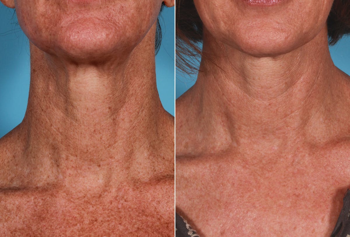 Lasers Before & After Gallery - Patient 125257 - Image 9
