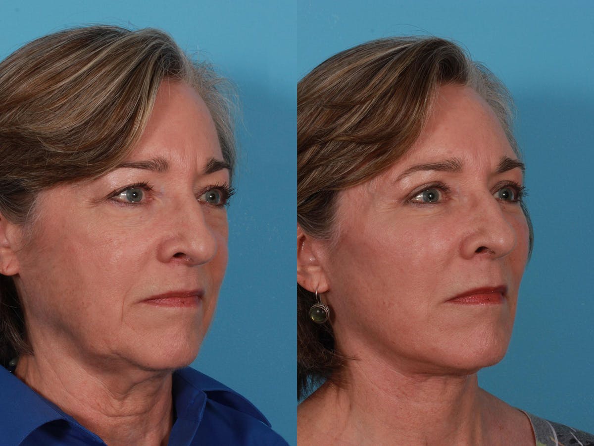 Facelift Before & After Gallery - Patient 162923 - Image 4
