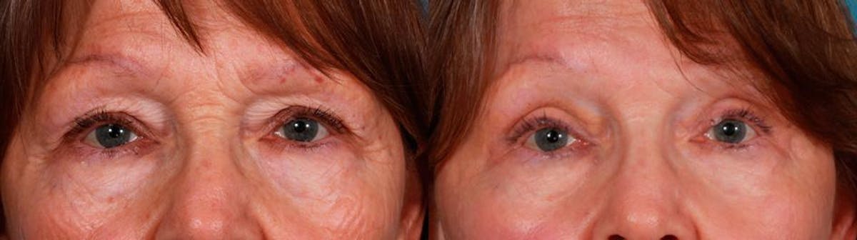 Eyelid Surgery (Blepharoplasty) Before & After Gallery - Patient 115560 - Image 4