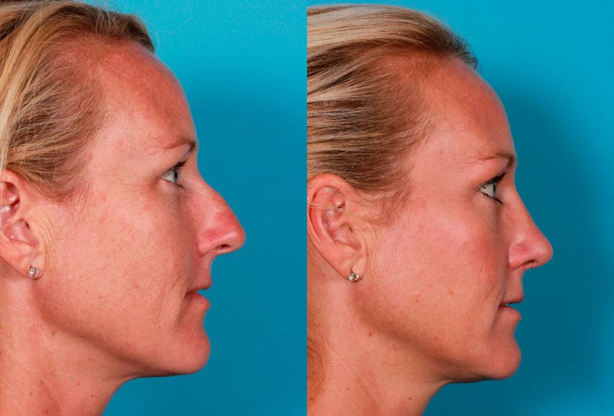 Rhinoplasty Before & After Gallery - Patient 124474 - Image 2