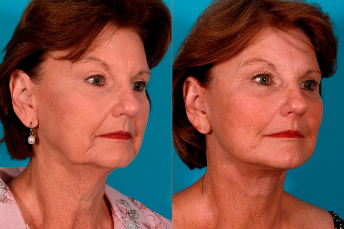 Facelift Before & After Gallery - Patient 274872 - Image 2