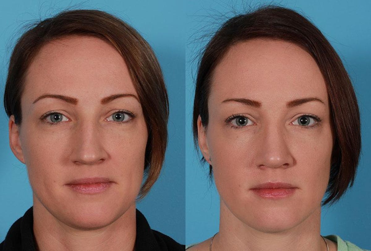 Rhinoplasty Before & After Gallery - Patient 795474 - Image 1