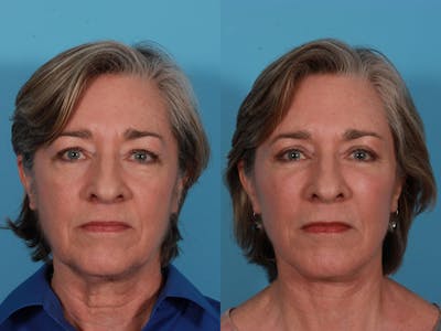 Facial Fat Transfer Before & After Gallery - Patient 195460 - Image 1