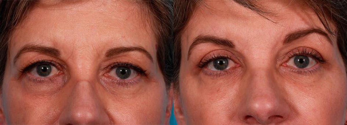 Eyelid Surgery (Blepharoplasty) Before & After Gallery - Patient 200071 - Image 3