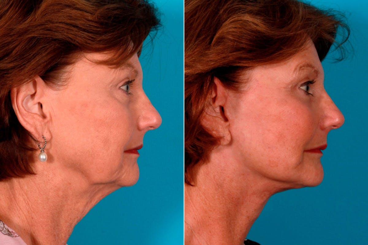 Facelift Before & After Gallery - Patient 274872 - Image 3