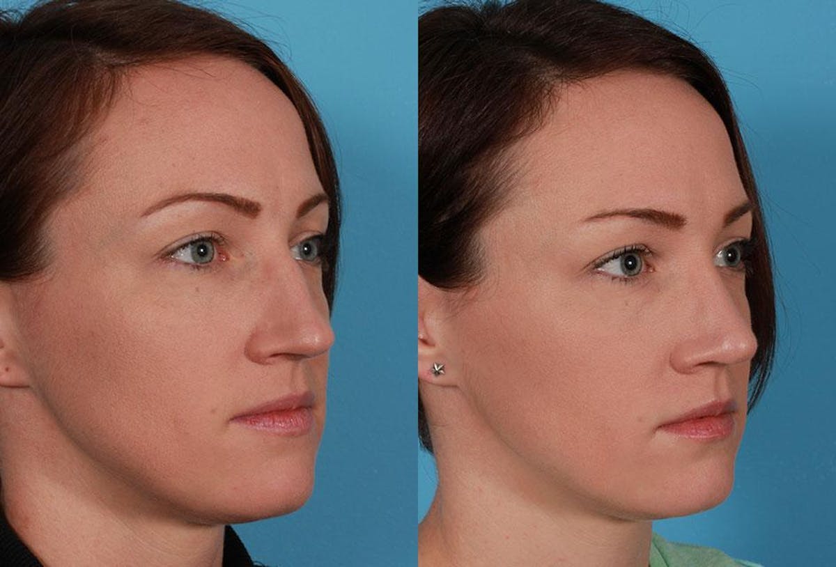 Rhinoplasty Before & After Gallery - Patient 795474 - Image 3