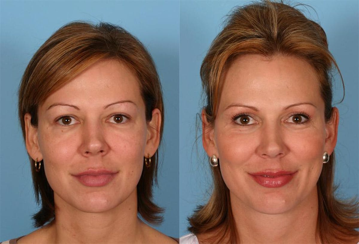Eyelid Surgery (Blepharoplasty) Before & After Gallery - Patient 334441 - Image 1