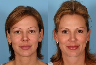 Eyelid Surgery (Blepharoplasty) Before & After Gallery - Patient 334441 - Image 1