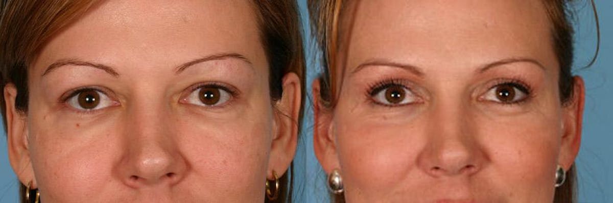Eyelid Surgery (Blepharoplasty) Before & After Gallery - Patient 334441 - Image 2