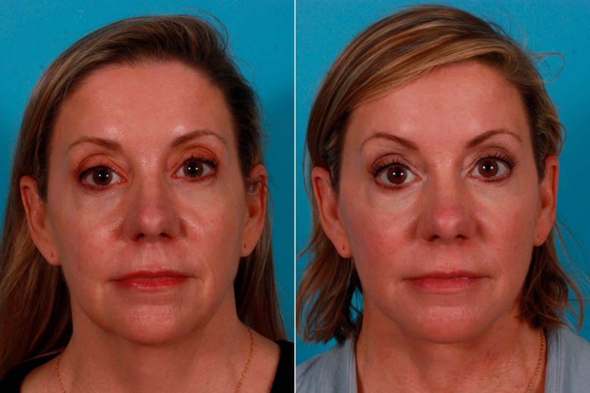 Facelift Before & After Gallery - Patient 234969 - Image 1