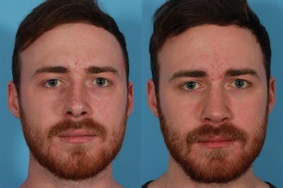 Rhinoplasty Before & After Gallery - Patient 292929 - Image 1