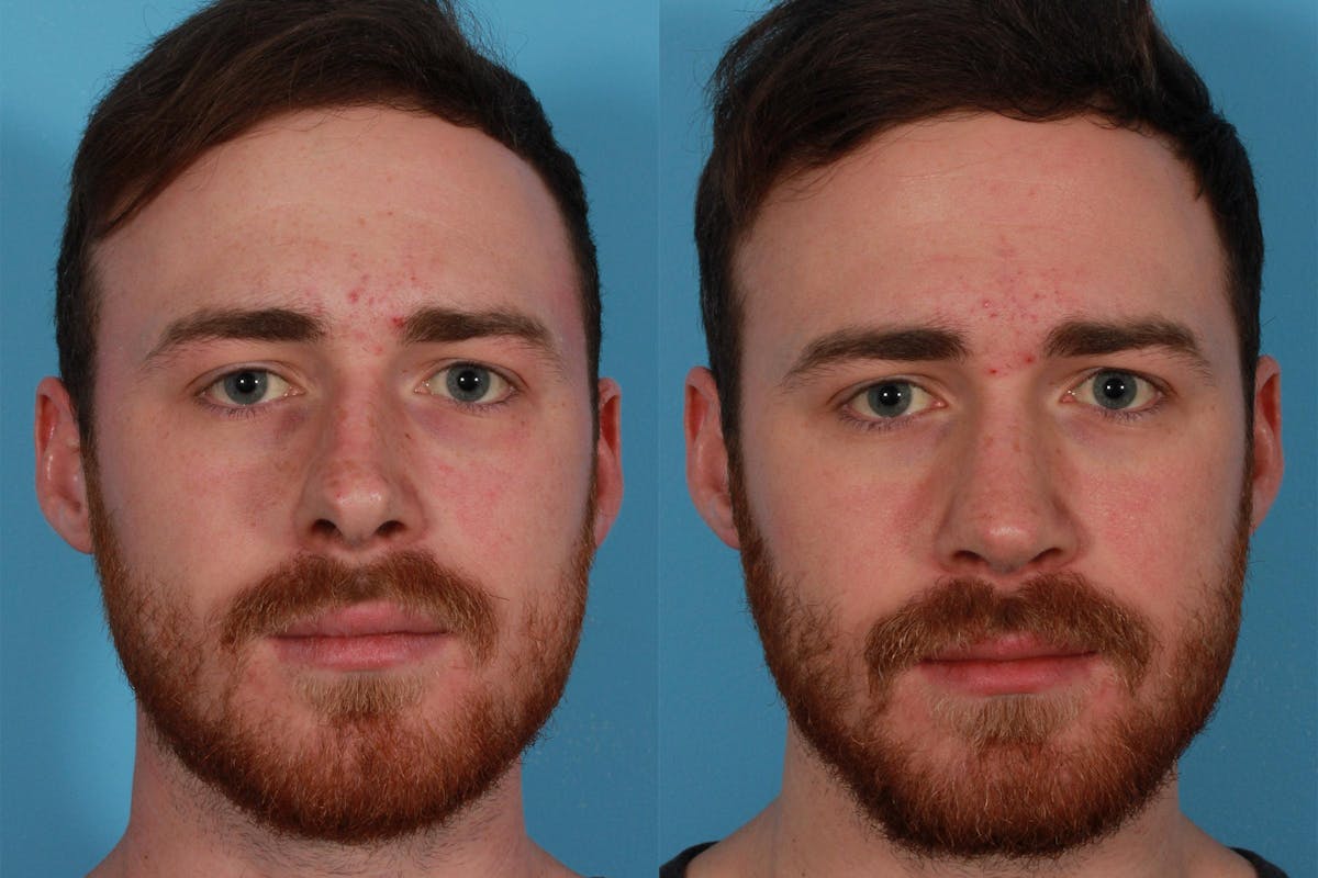 Rhinoplasty Before & After Gallery - Patient 292929 - Image 1