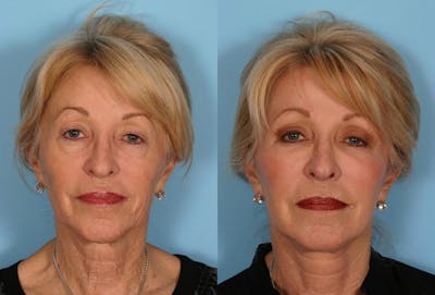 TCA Peel / Dermabrasion Before & After Gallery - Patient 309780 - Image 1