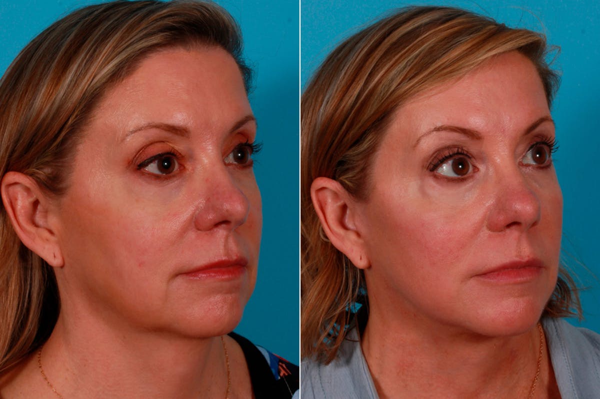 Facelift Before & After Gallery - Patient 234969 - Image 2