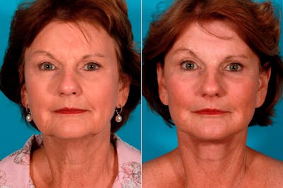 Facial Fat Transfer Before & After Gallery - Patient 207546 - Image 1