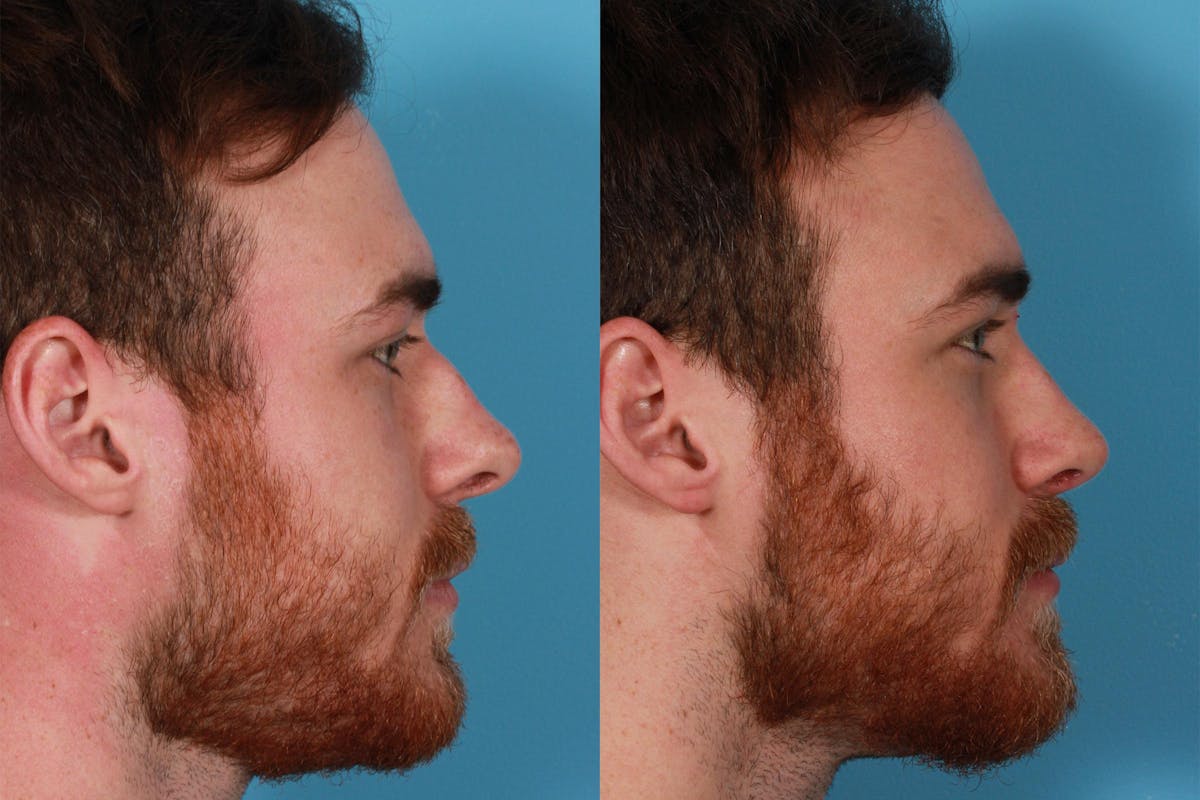Rhinoplasty Before & After Gallery - Patient 292929 - Image 2
