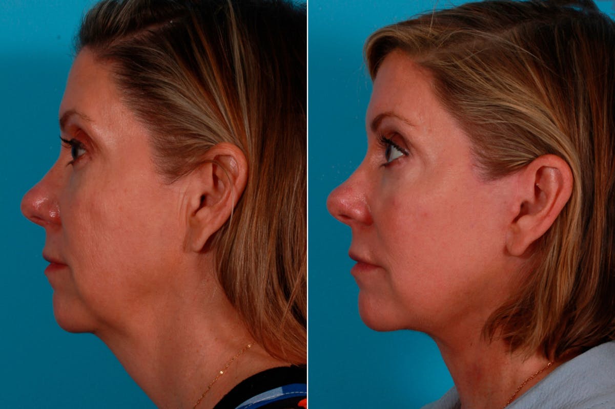 Facelift Before & After Gallery - Patient 234969 - Image 3