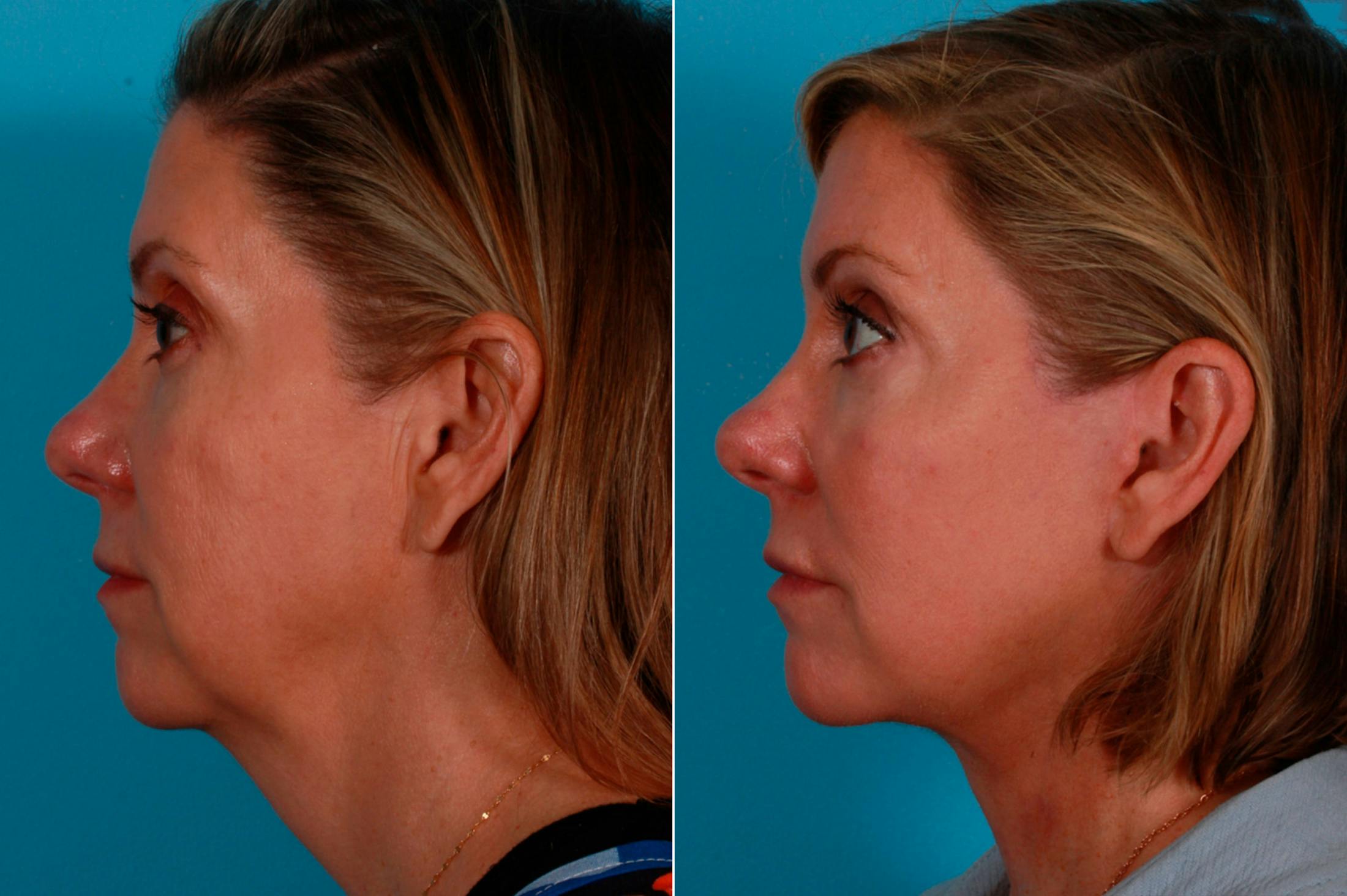 Facelift Before & After Gallery - Patient 234969 - Image 3