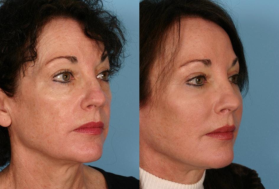 TCA Peel / Dermabrasion Before & After Gallery - Patient 105258 - Image 2