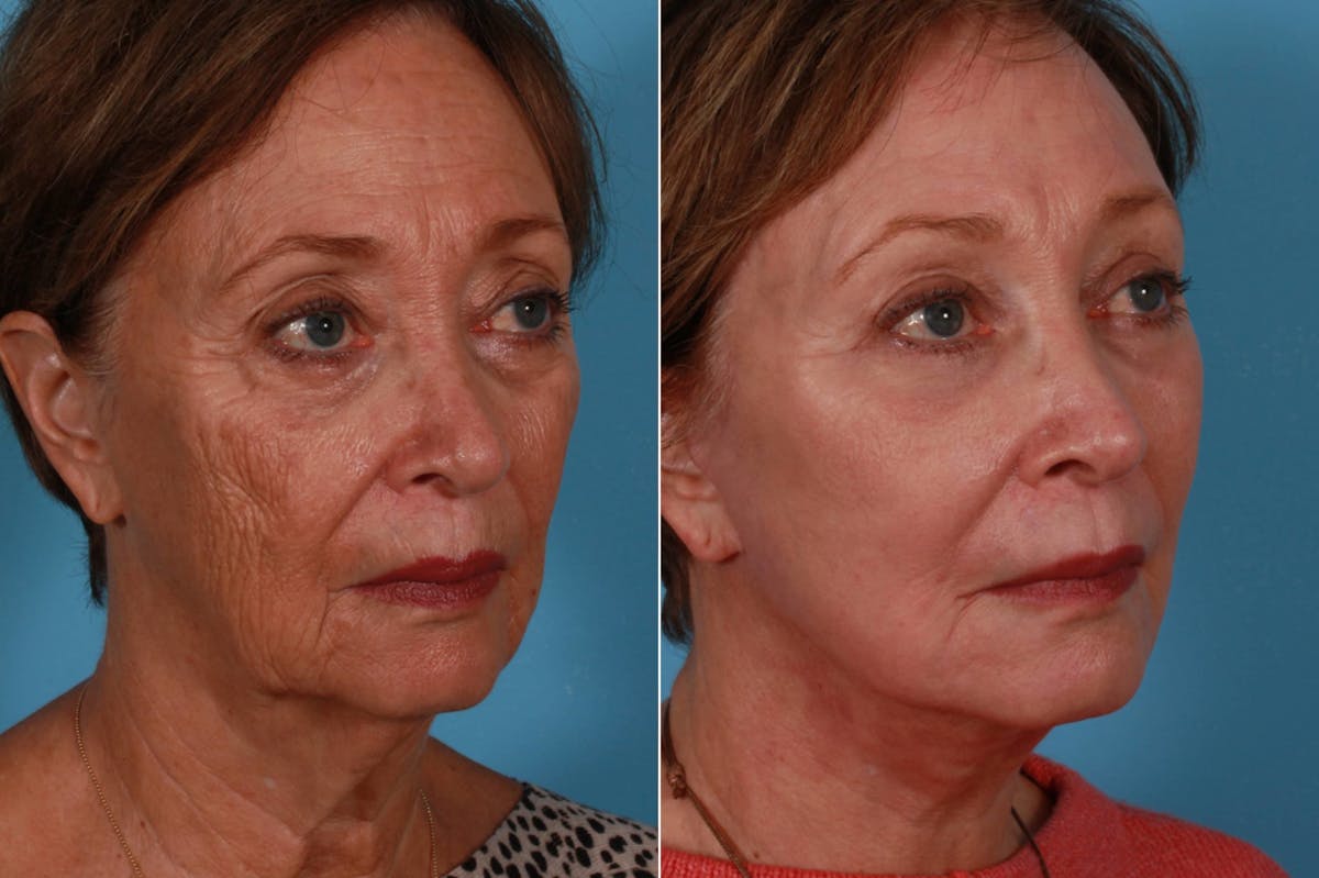 Facelift Before & After Gallery - Patient 579531 - Image 2