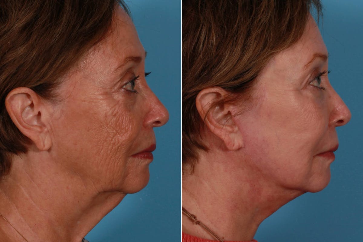 Facelift Before & After Gallery - Patient 579531 - Image 3