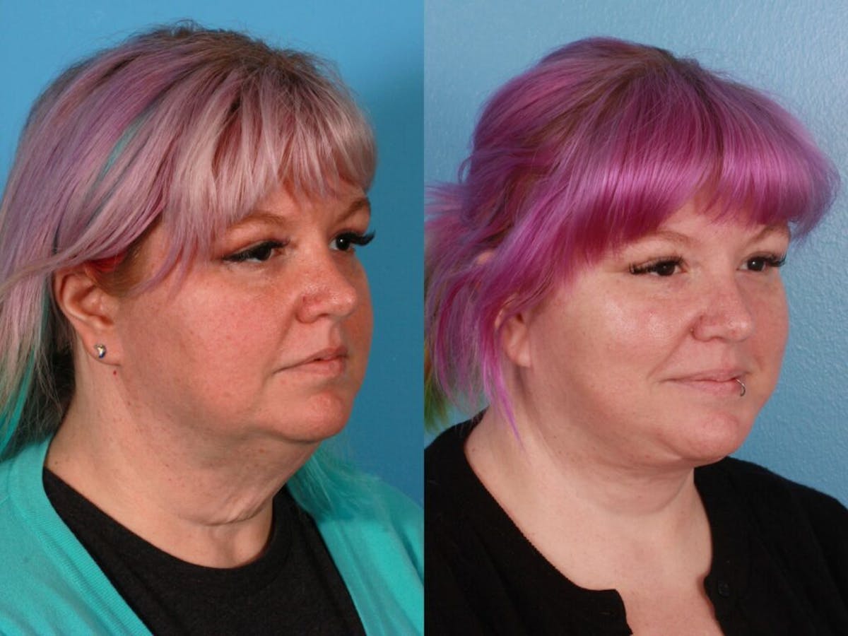 Facelift Before & After Gallery - Patient 108424 - Image 2