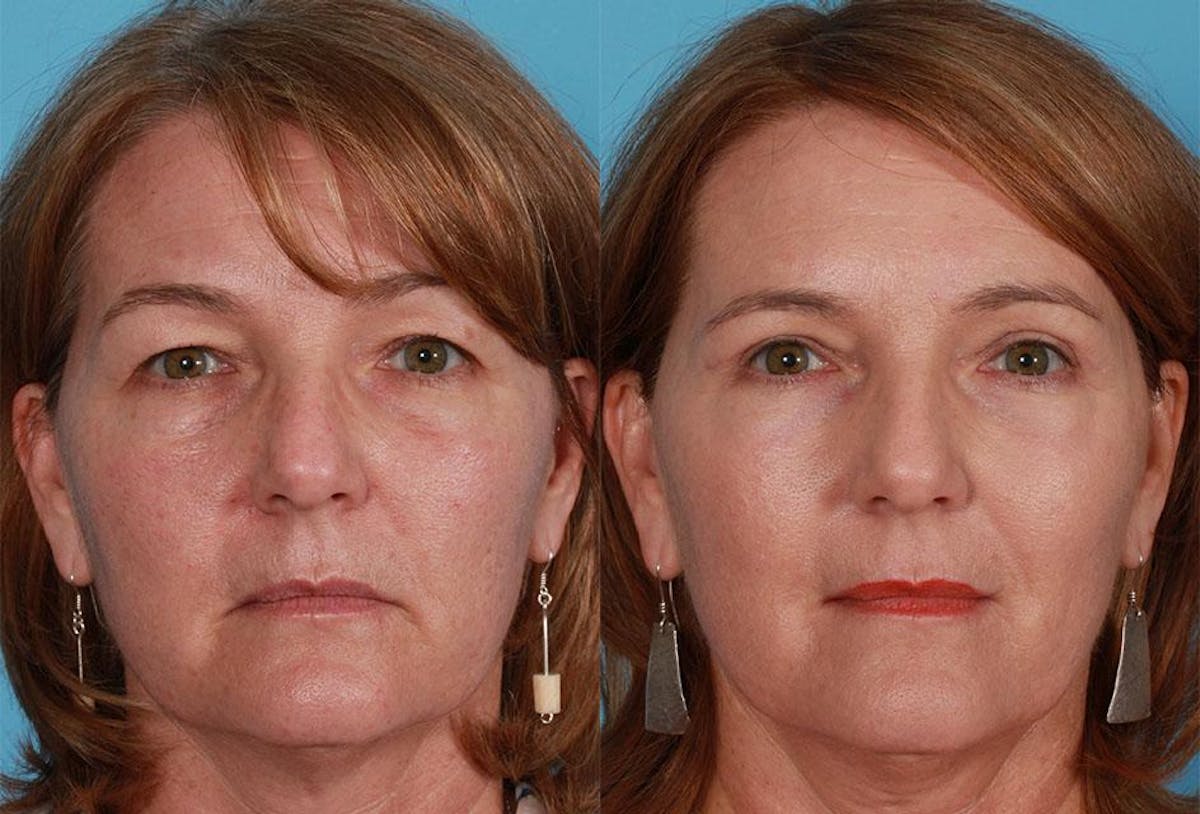 Eyelid Surgery (Blepharoplasty) Before & After Gallery - Patient 237934 - Image 1