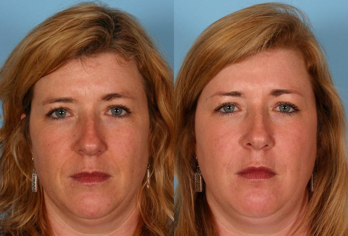 Restylane Before & After Gallery - Patient 413575 - Image 1