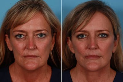 Facial Fat Transfer Before & After Gallery - Patient 240783 - Image 1