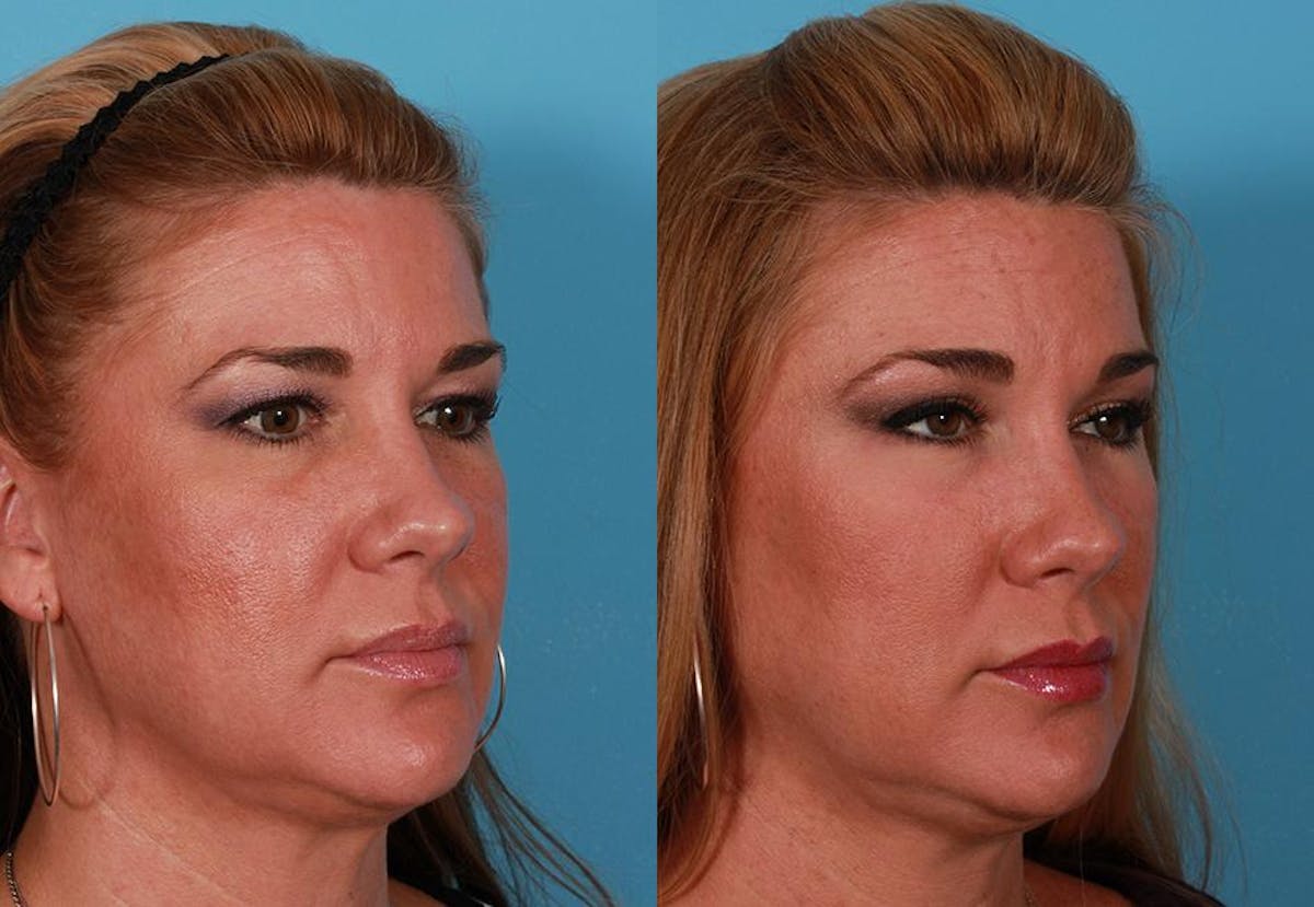 TCA Peel / Dermabrasion Before & After Gallery - Patient 319055 - Image 2