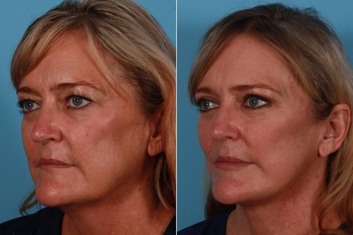 Facial Fat Transfer Before & After Gallery - Patient 240783 - Image 2