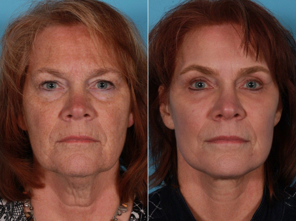 Facelift Before & After Gallery - Patient 388732 - Image 1
