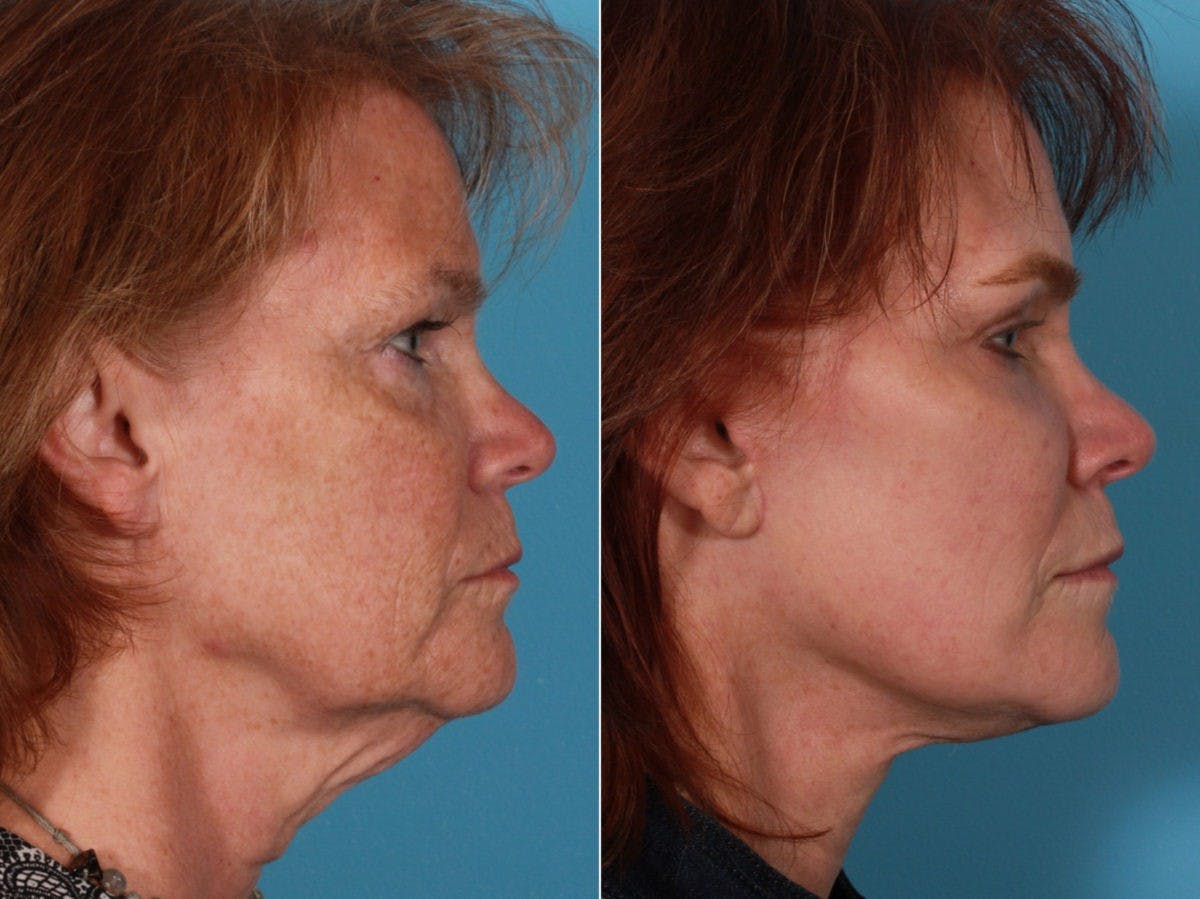 Facelift Before & After Gallery - Patient 388732 - Image 2