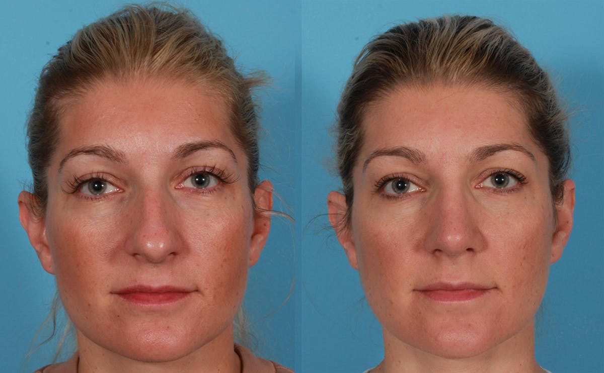 Rhinoplasty Before & After Gallery - Patient 232152 - Image 1