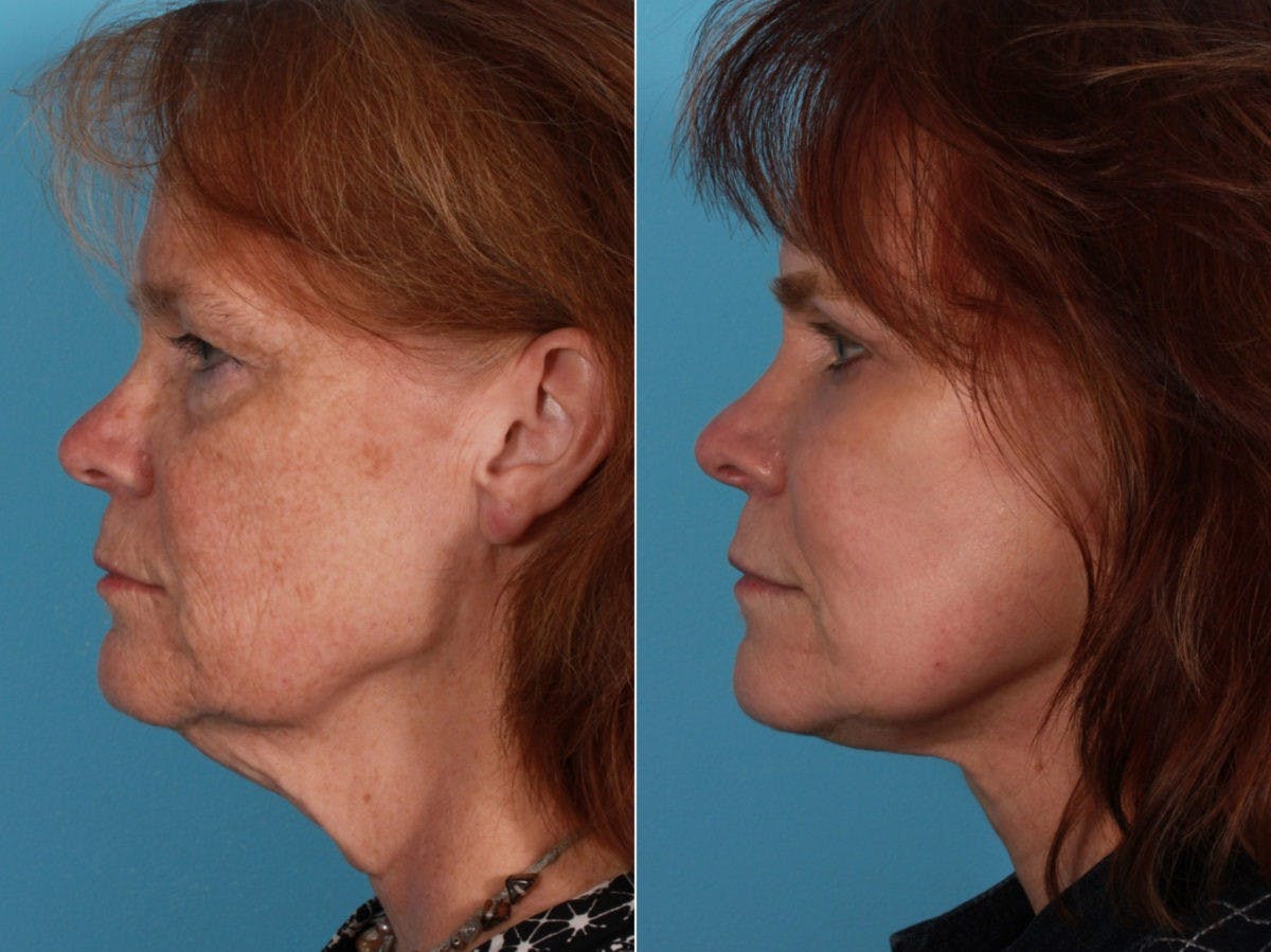 Facelift Before & After Gallery - Patient 388732 - Image 3