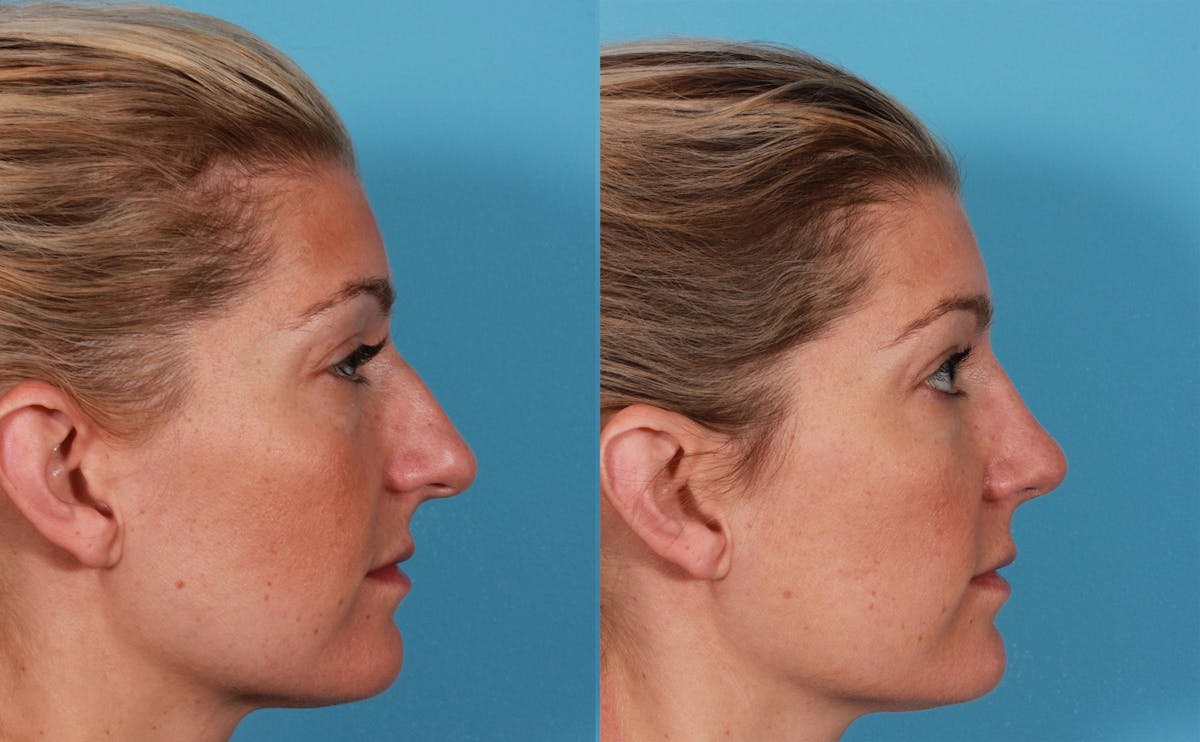 Rhinoplasty Before & After Gallery - Patient 232152 - Image 2