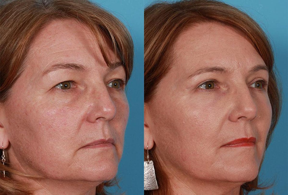TCA Peel / Dermabrasion Before & After Gallery - Patient 188182 - Image 2