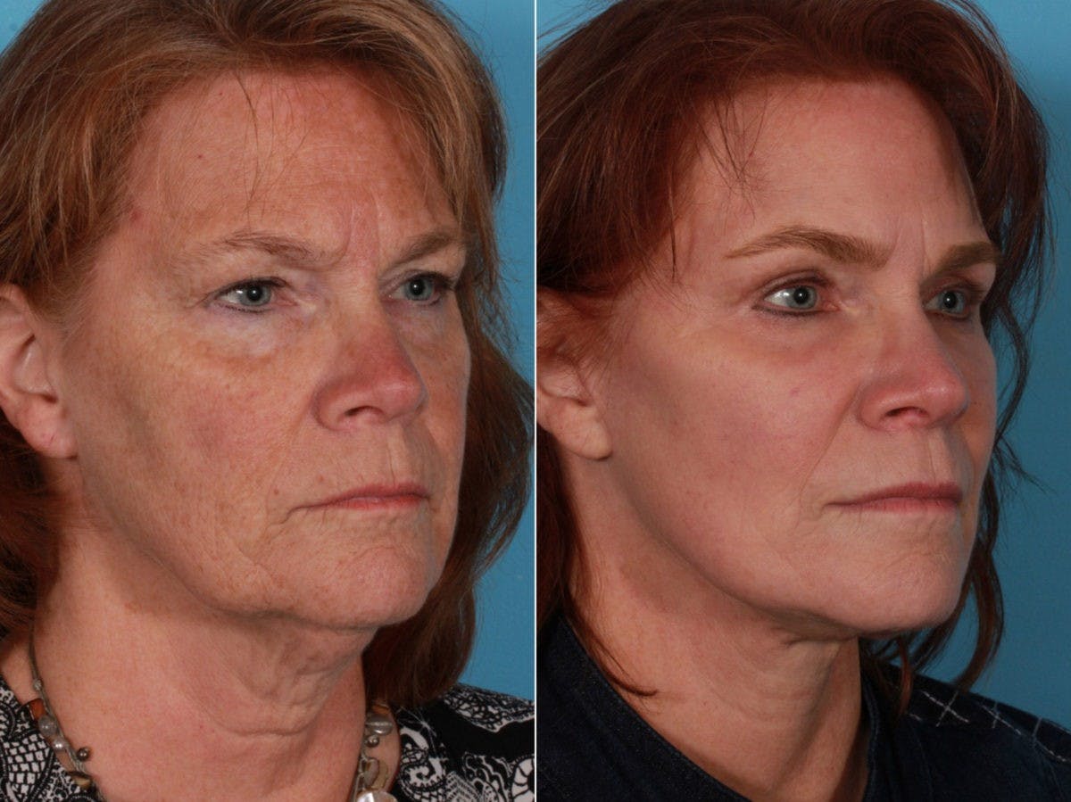Facelift Before & After Gallery - Patient 388732 - Image 4