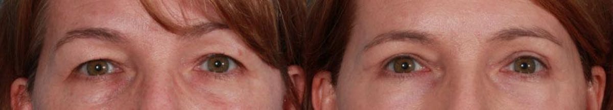 TCA Peel / Dermabrasion Before & After Gallery - Patient 188182 - Image 3