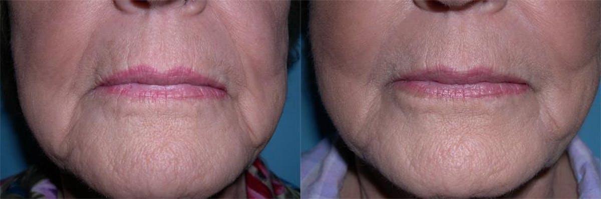 Restylane Before & After Gallery - Patient 109866 - Image 1