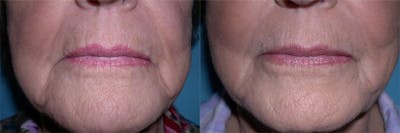 Restylane Before & After Gallery - Patient 109866 - Image 1