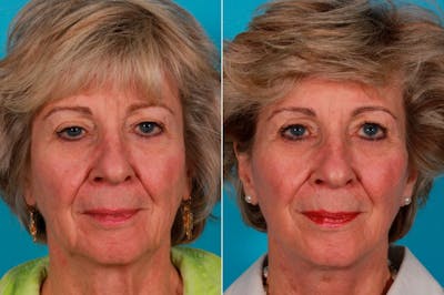Facelift Before & After Gallery - Patient 181736 - Image 1